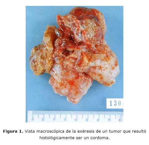 Vista macroscópica de la excéresis de un tumor