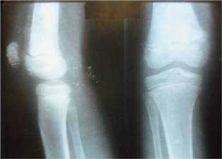 Rayos x antero-posterior y lateral de rodilla derecha